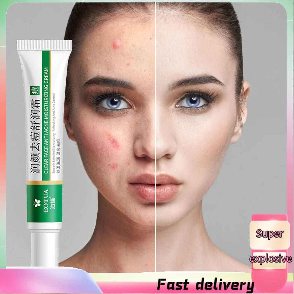 【TTLIFE】Effective Acne Removal Cream Acne Treatment Anti Acne Pimples Refreshing Soothing Oil Control Shrink Pores Whitening Moisturizing Skin Care