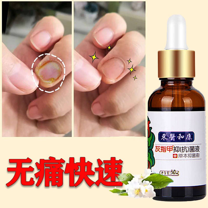 灰指甲药 灰指甲特效药增厚快速治疗甲沟炎抑菌液软甲亮甲专用药灰甲净药水 Shopee Malaysia