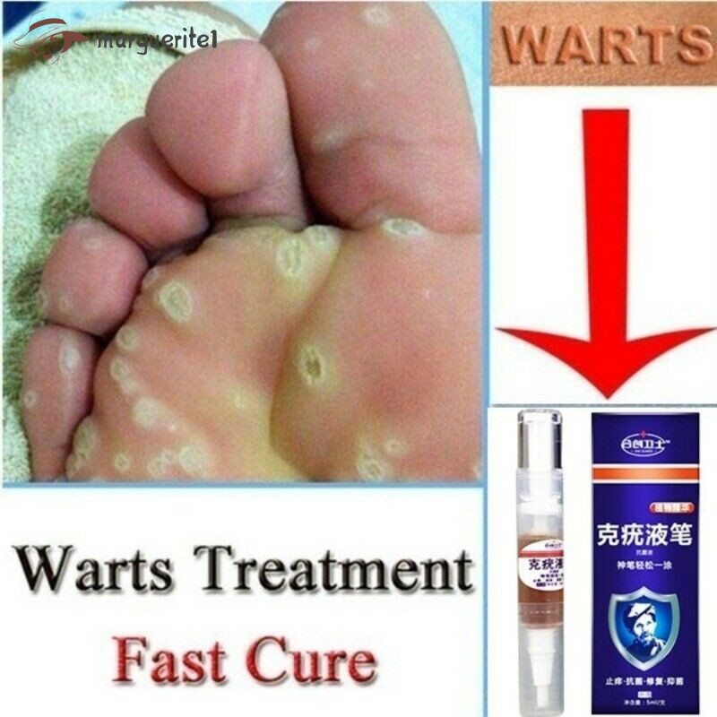 Plantar Wart Remover Corn Callus Remover Naturals Removal