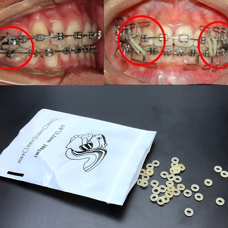 orthodontic elastic rubber bands