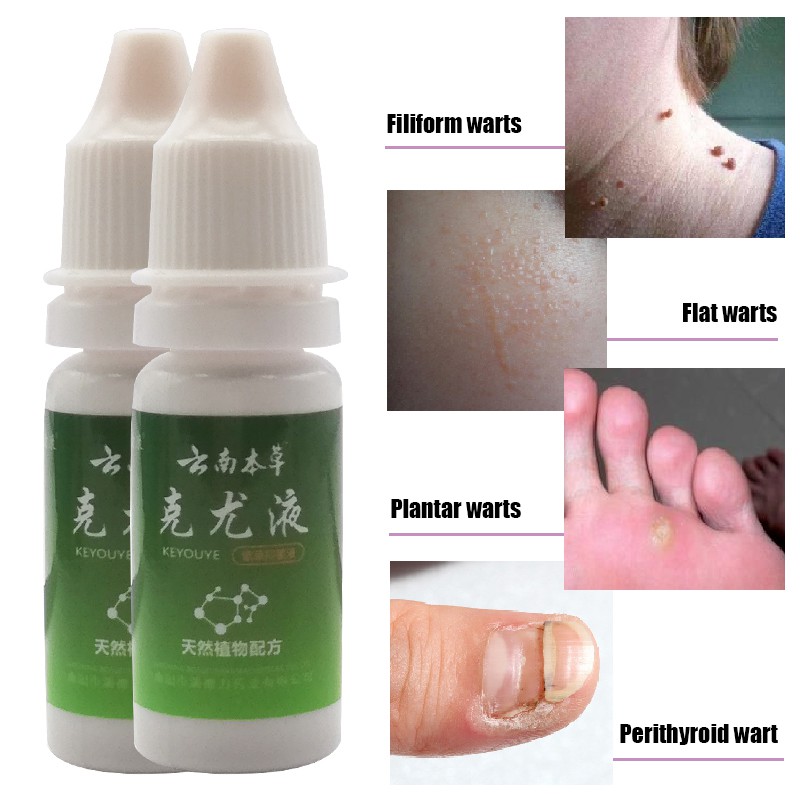 Wart Remover Rapidly Against Mole Warts Drop Papillomas Treatment Skin Tag Ointment Chinese Medicine Spray Per Shopee Malaysia