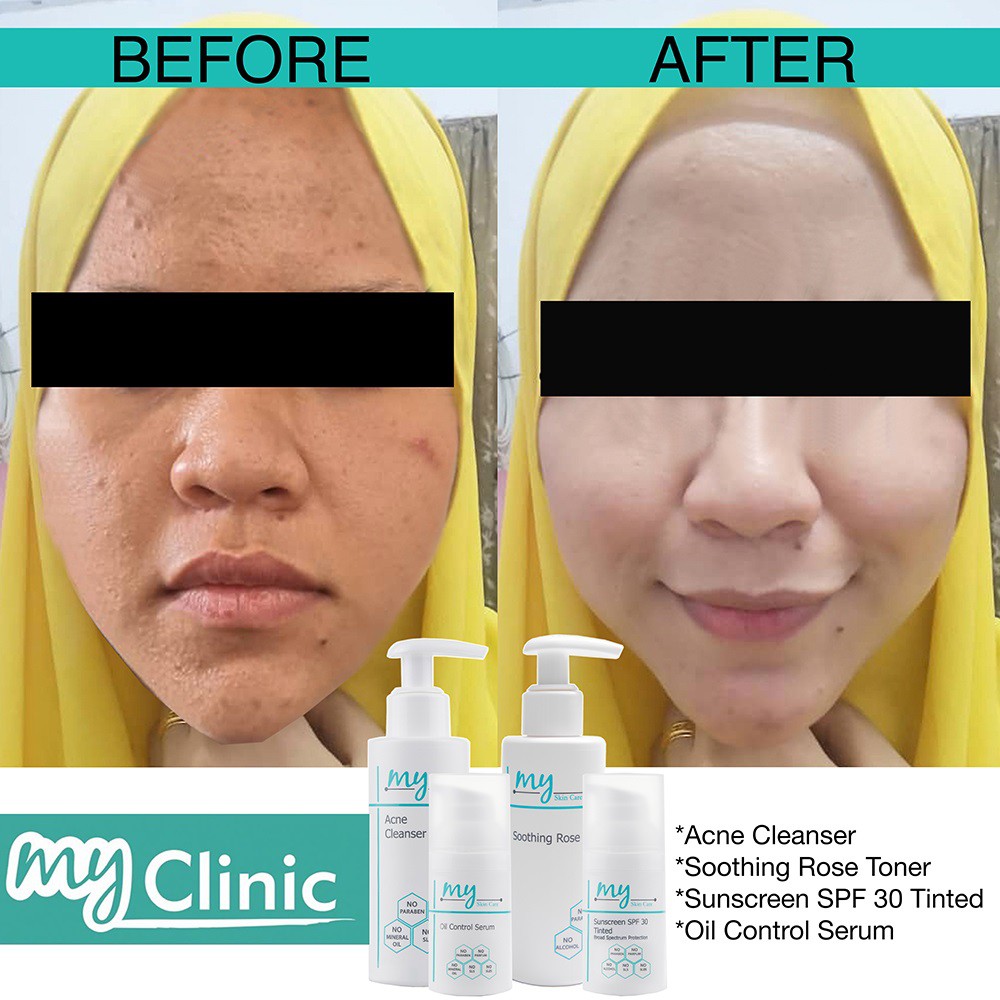 myclinic acne cleanser