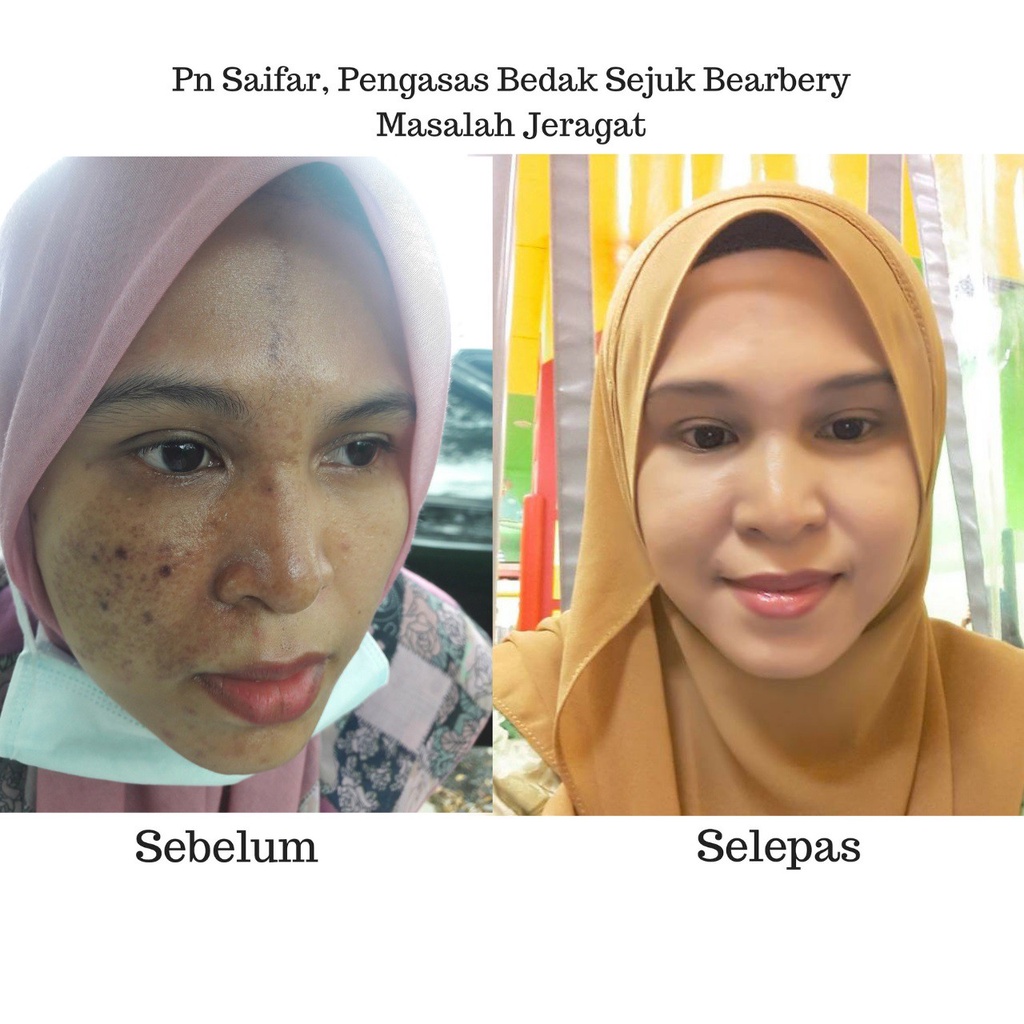 Xhundara Skincare Kulit Cantik Selepas Dua Minggu