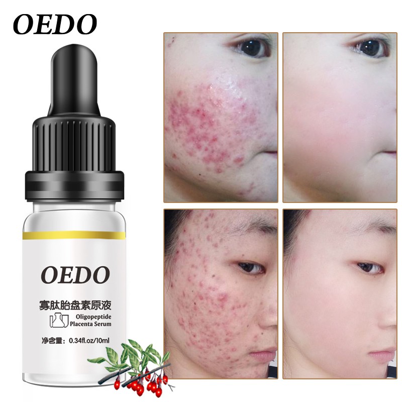 oligopeptide acne serum