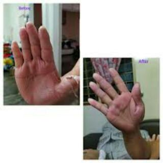 TJHYML Eczema Skin Itchy Cream / Krim Tradisional Ubat 