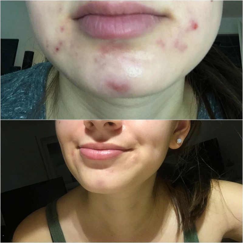 moisturizer for epiduo