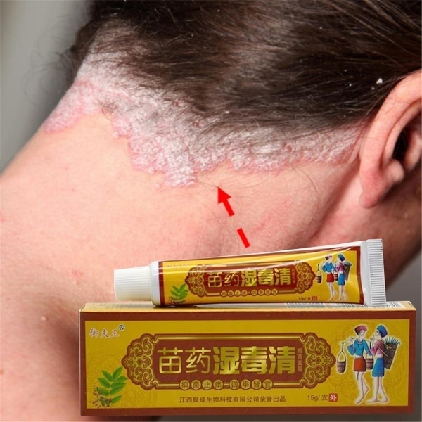 Health Care Skin Fungus Anti Bacterial Cream Natural Chinese Herbs