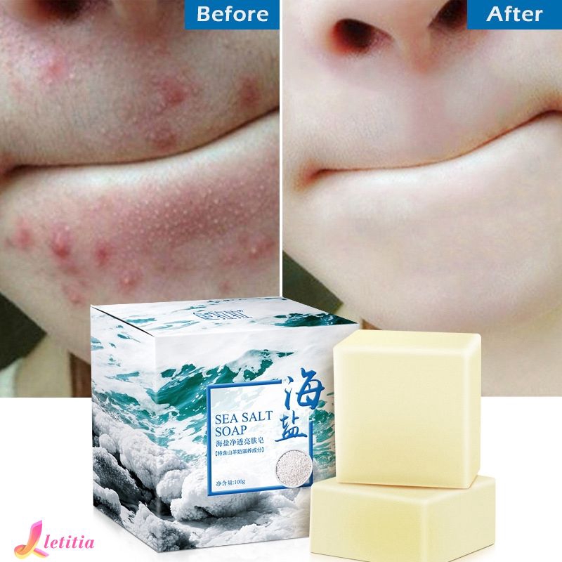 le acne soap