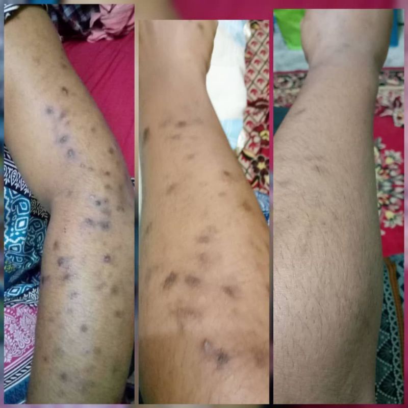 Hilangkan Parut Kaki Tangan Muka Dan Badan Shopee Malaysia