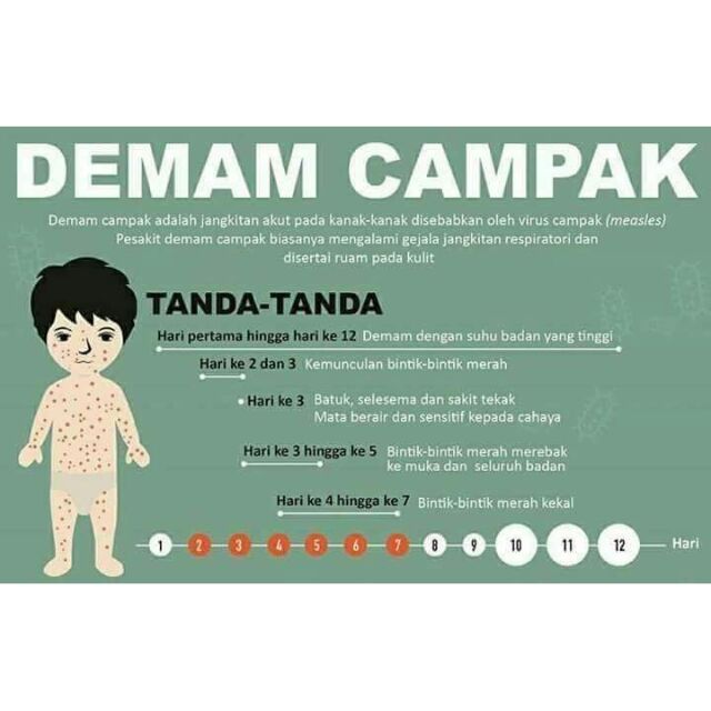 Campak bayi demam Anak Terkena