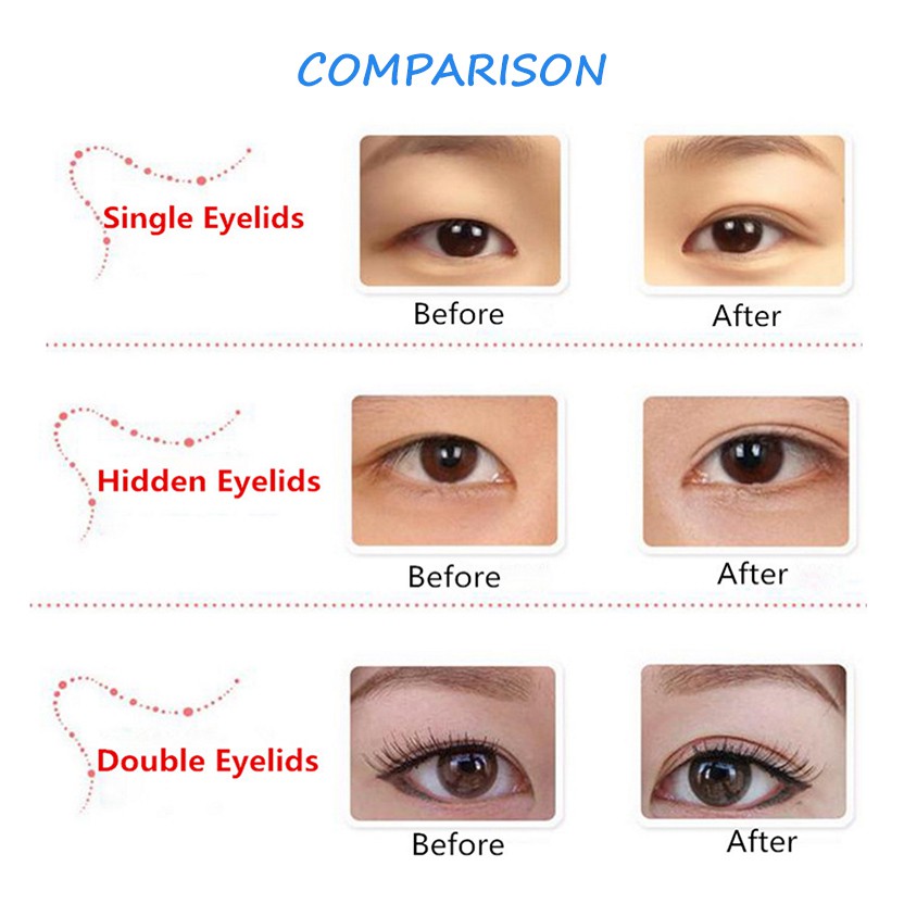 single eyelid double eyelid