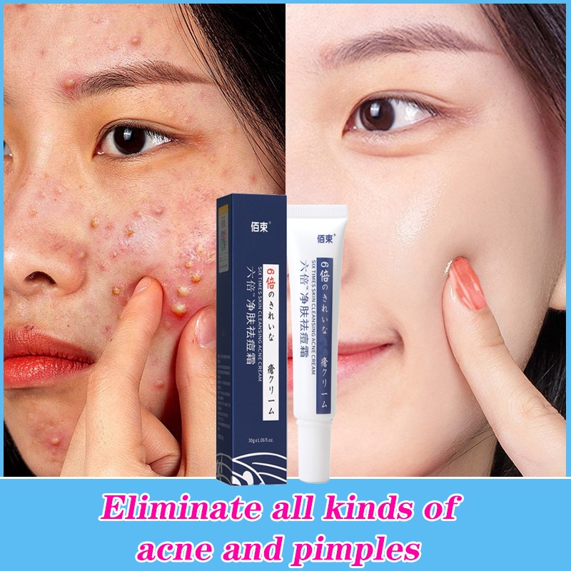 Acne cream pimple cream acnes acne cleanser Scar Repair Gel Caesarean