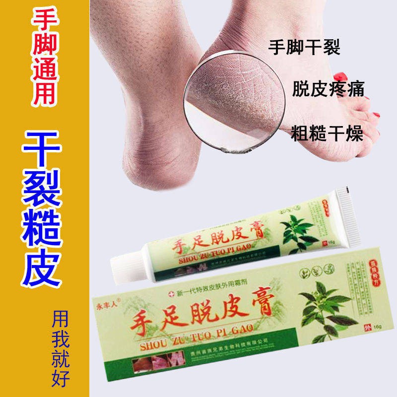 Hand and foot molting cream for treating hand itching peeling skin