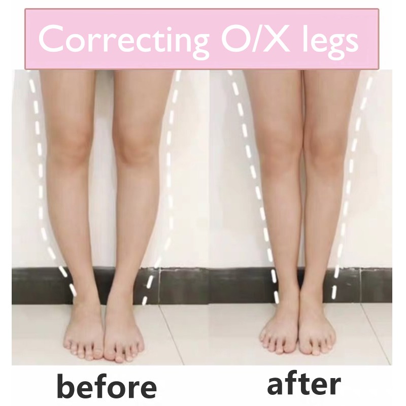 X O Type Leg Correction Belt Galligaskins Charming Legs Shaping Beauty 3pcs Shopee Malaysia