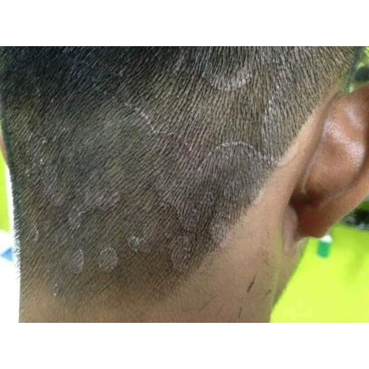 Kulit Kepala Kelemumur Kulit Kepala Berkuping Kulit Kepala Gatal Rambut Gugur Ubat Kelemumur Shopee Malaysia