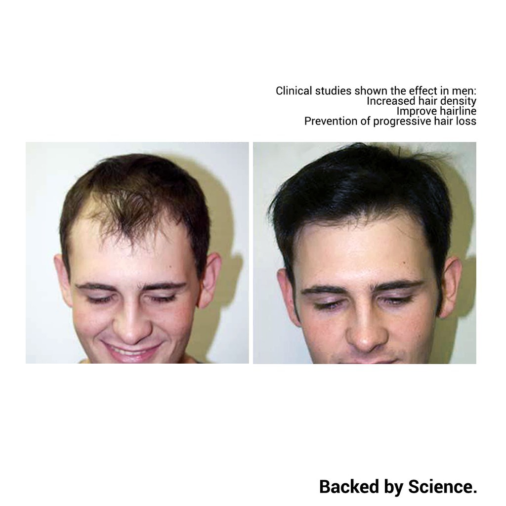 DermaMed+ Hair Regrowth & Hair Loss Prevention For Men | Minoxidill, Add on  Biotin Shampoo | Shopee Malaysia