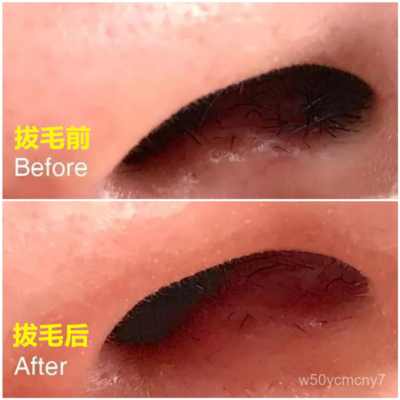 hot wax nose hair removal