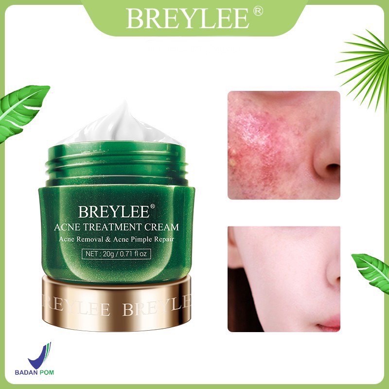 Breylee Acne Treatment Cream 20g | Shopee Malaysia