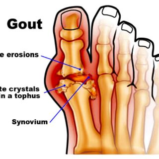 JUS MUSTAJAB BAGI UBAT GOUT RESDUNG TAMBAH SELERA MAKAN 