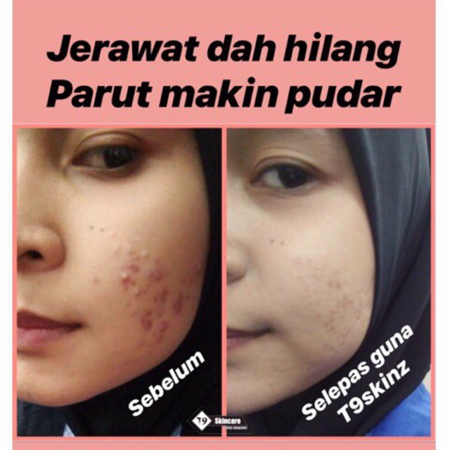 Hilang Jerawat Batu Resdung Dengan Berkesan Shopee Malaysia