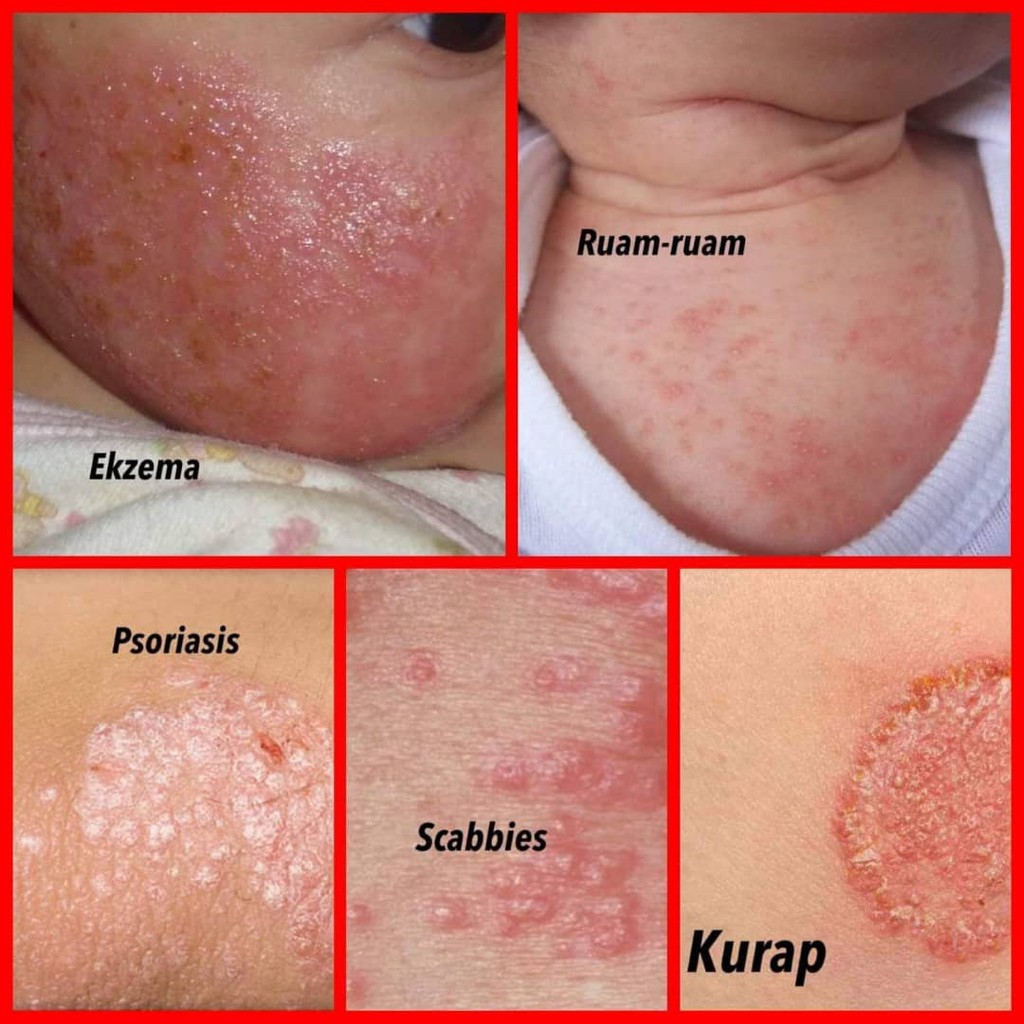 Kesan Ubat Psoriasis - Pemudi b