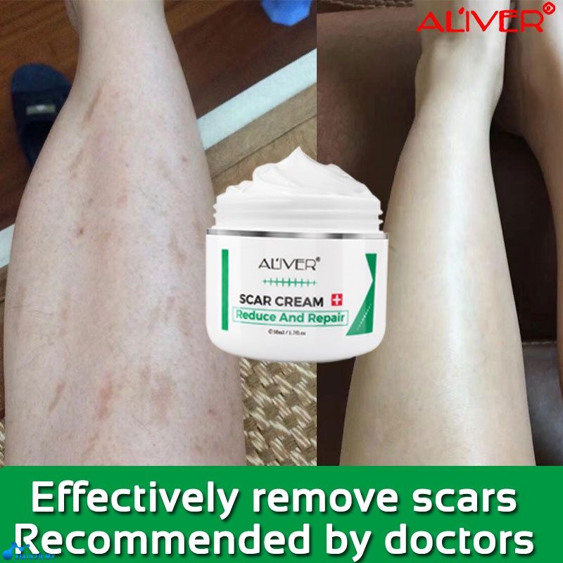 ALIVER Scar Removal Cream Scar Repair Cream For New Old Scars Acne