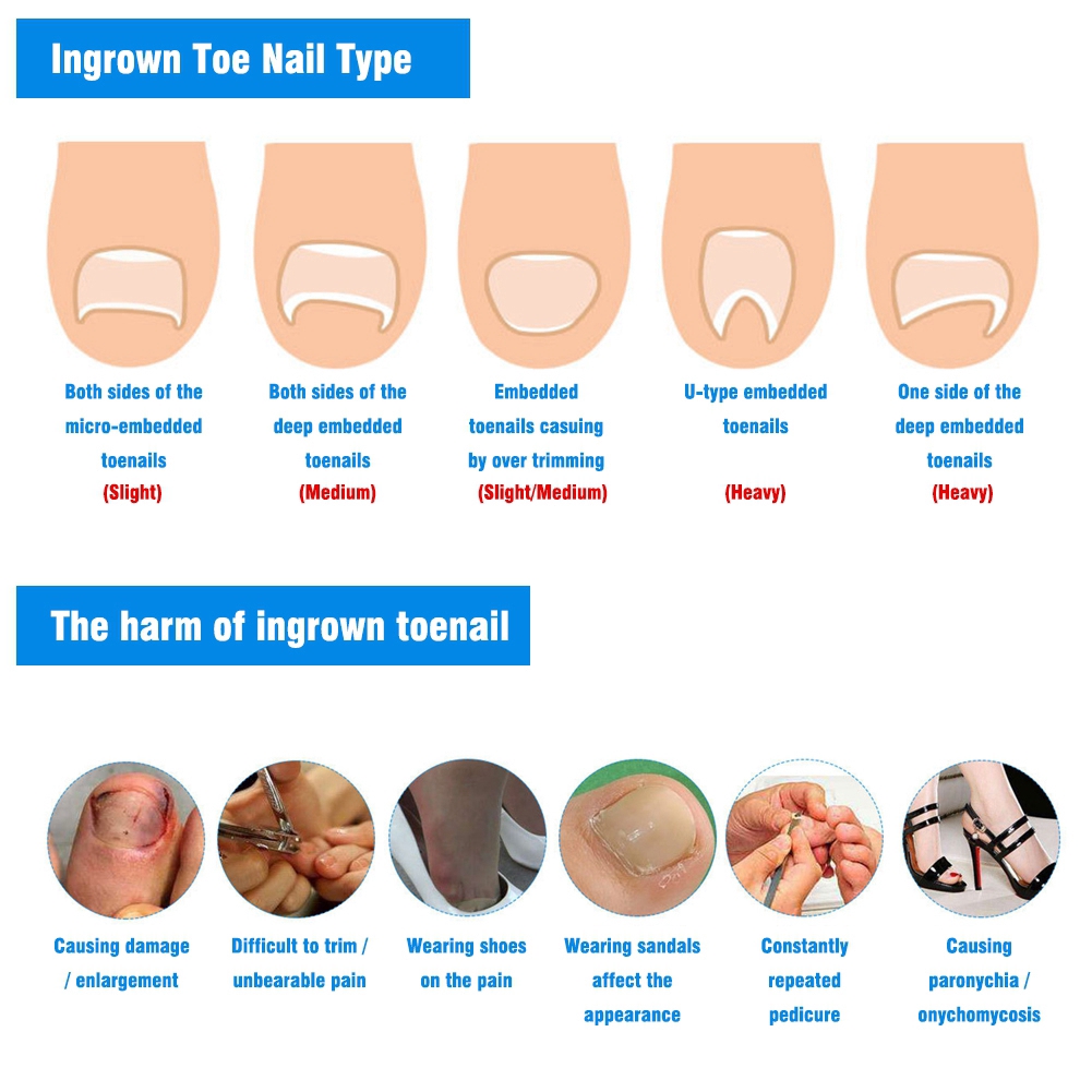 Correction Toenail Fixer Patch Pedicure Nail Recover Tool Ingrown