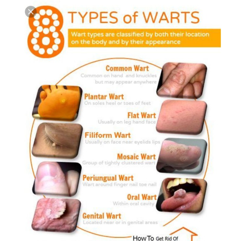 Ready Stock Malaysia Genital Warts Removal Skintag Removal Shopee