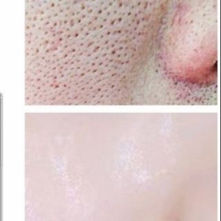 Serum hilangkan PARUT💥dan kesan jerawat viral + ubat 