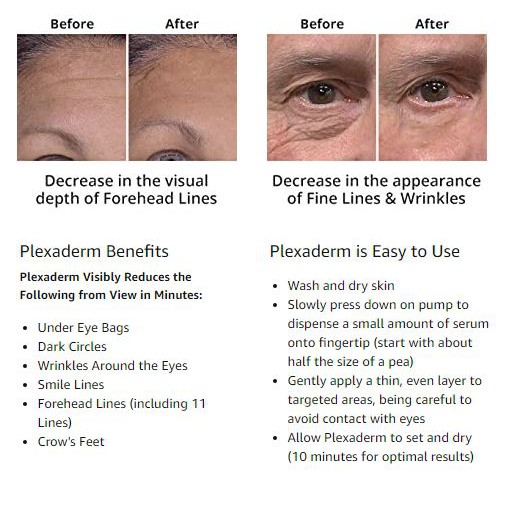 plexaderm forehead wrinkles