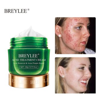 Breylee Acne Treatment Face Cream Anti Acne Pimple Oil Control Remove Pimples Moisturizer