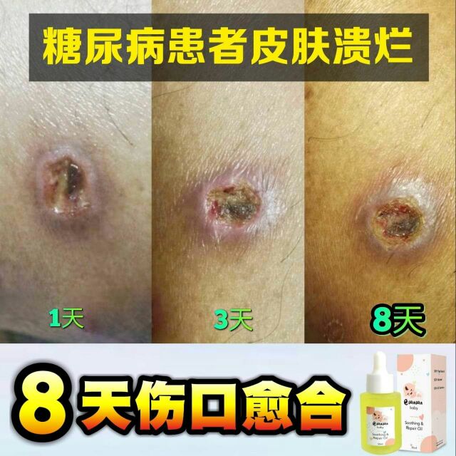 Ewawa 医娃娃效果太棒了👏👏 8天伤口愈合u203c️u203c️ 看图看图看图 