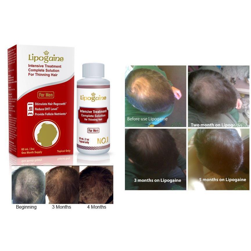 Hair Growth Lipogaine Tonic Lipogaine Shampoo Hairloss Rogaine