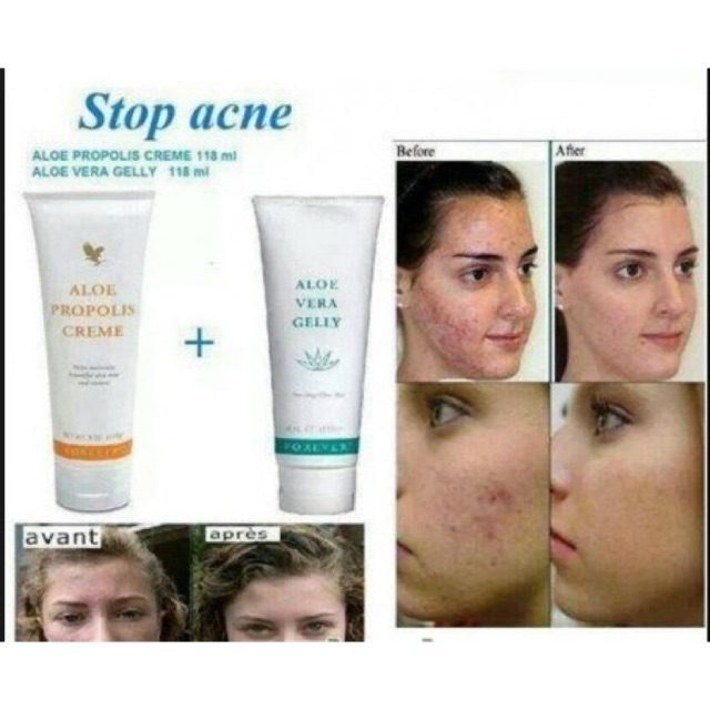 for Acne -Propolis Creme + Aloe Vera Gelly | Shopee Malaysia