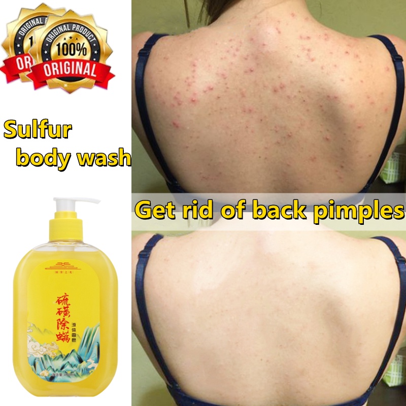 Acne Body Wash Remove Acne Mites back acne sulfur soap Sulfur Shower