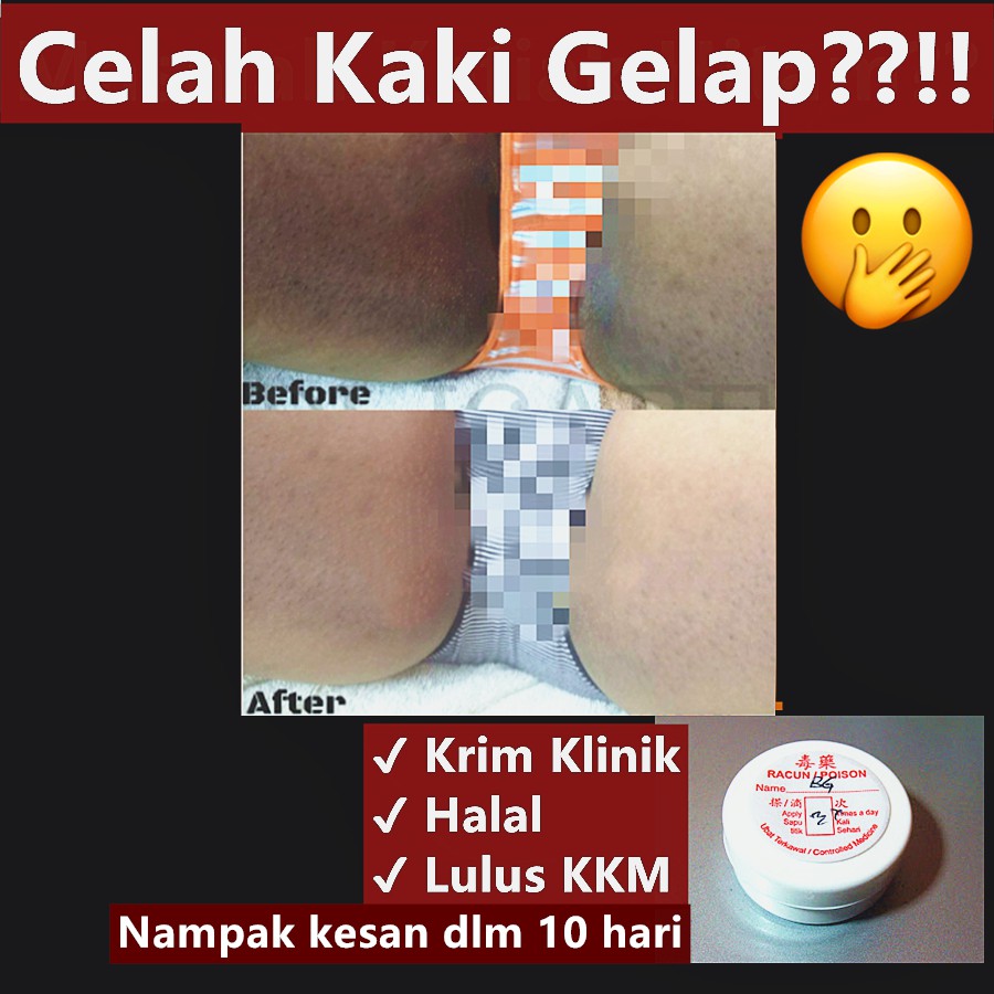 Buy Krim Cerah Untuk Celah Kaki Hitam Gelap Klinik Kulit Celah Paha Whitening Cream Clinic Body Halal Seetracker Malaysia