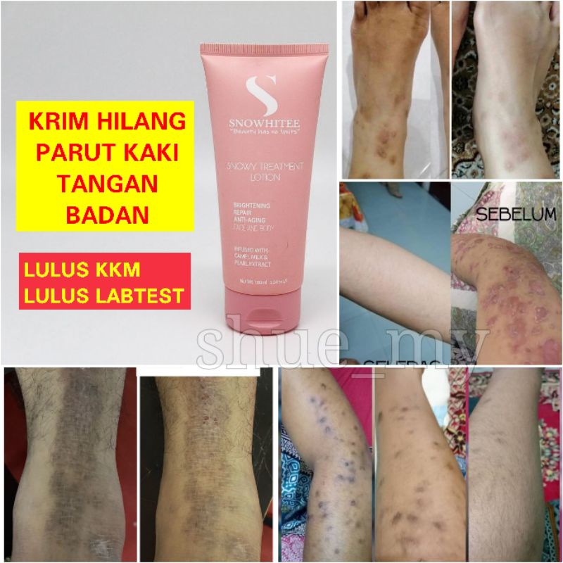 Ubat Hilangkan Parut Kudis Di Kaki