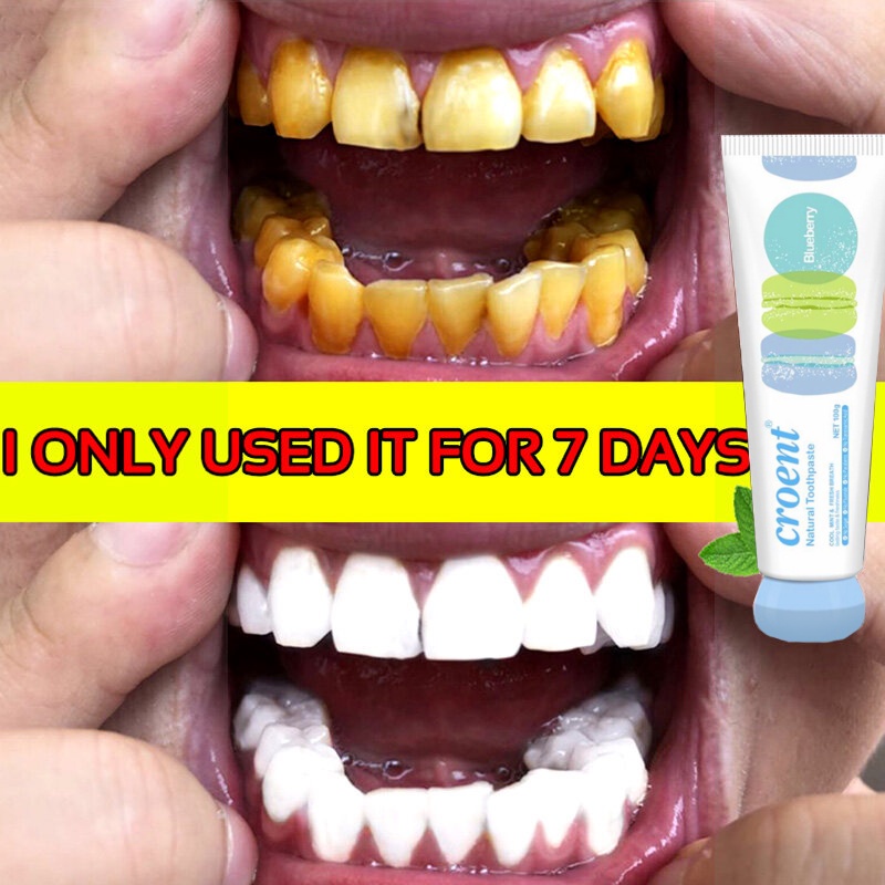 Ubat Gigi Kuning Pemutih Teeth Whitening Toothpaste Remove Stone Originalç¾ç½çé½' Build Up Ubat Gigi Ukiwi Tooth Decay Shopee Malaysia