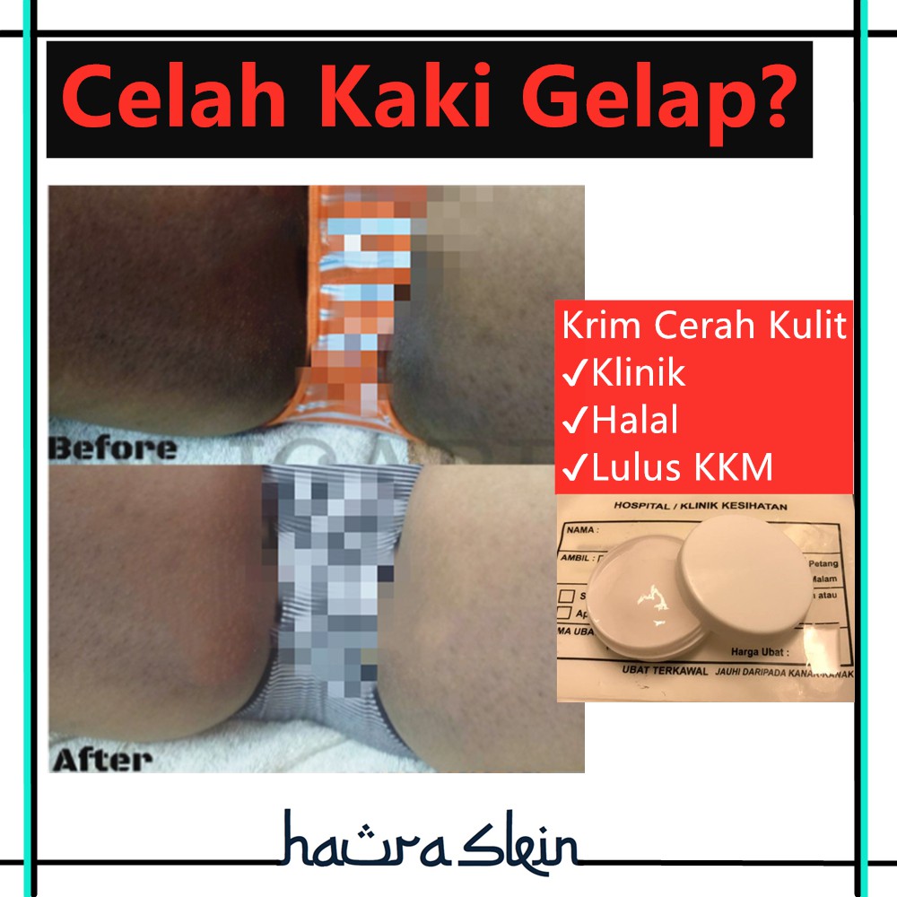 Buy Krim Cerah Untuk Celah Kaki Hitam Gelap Klinik Celah Paha Whitening Cream Clinic Body Halal Seetracker Malaysia