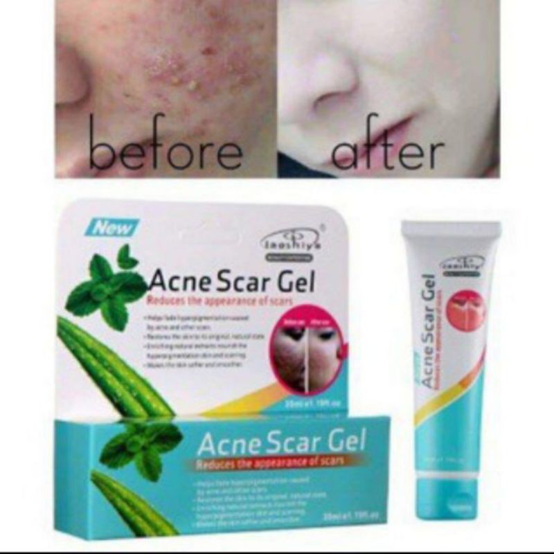 aloe-vera-acne-scar-gel-acne-scar-treatment-acne-pimple-spot-scar