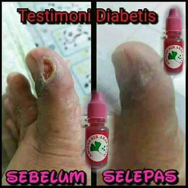 Best Product Ubat Luka Kencing Manis Diabetes Penyakit Kulit Kronik Eczema Amirna Akar Kayu Shopee Malaysia