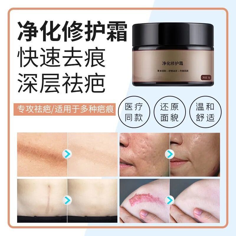 Buy N7sh The Old Scar Buster Removes The Scar Ointment To Remove The老疤克星去疤膏 去疤痕修复无痕脸上腿部手术疤痕烫伤印修复膏qianshi172 My 5 10 Seetracker Malaysia