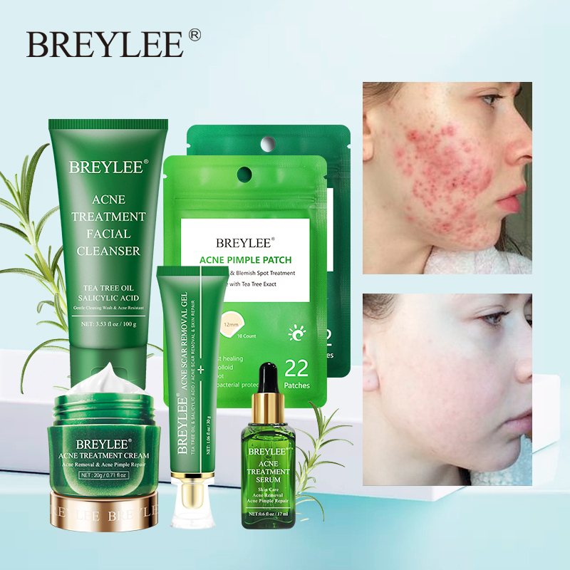 breylee acne treatment gel