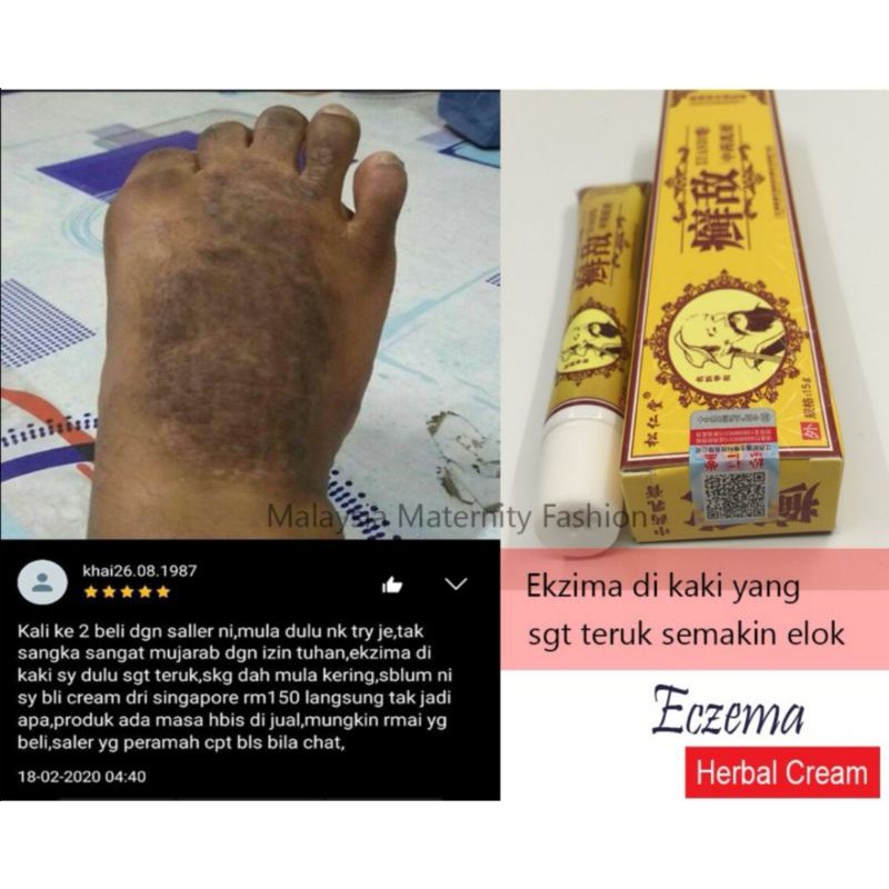 Ubat Kurap Paling Berkesan Tanpa Keluar Duit Banyak Hapuskan Gatal Gatal Anda Shopee Malaysia