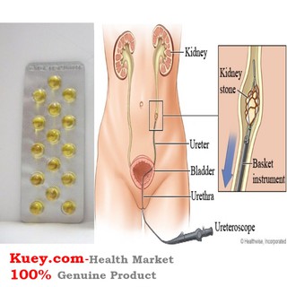 Ubat Batu Karang PUNDI KENCING, HEMPEDU & KIDNEY STONE 30 