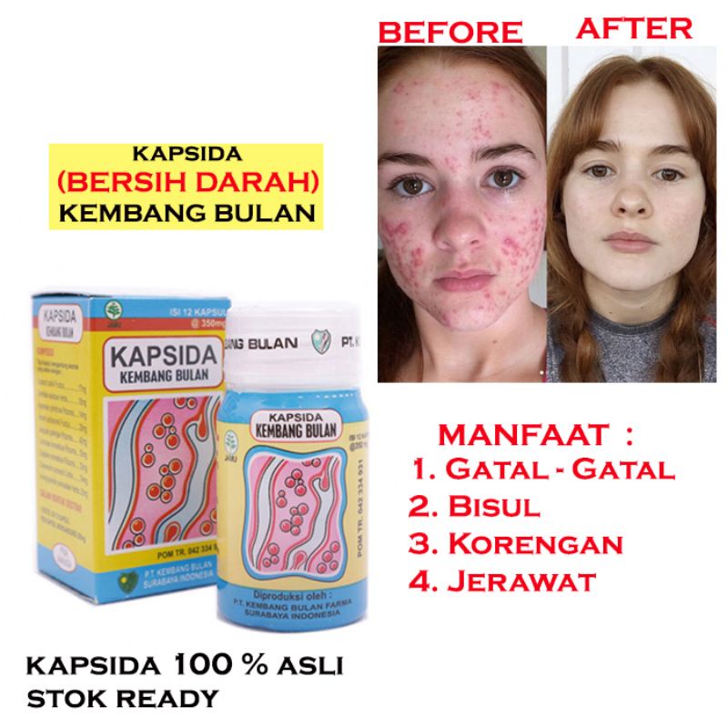 Obat Gatal Gatal Bisul Dan Jerawat Paling Manjur Kapsida Shopee Malaysia