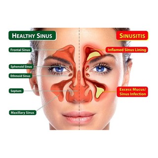 SINUS CARE - UBAT PENAWAR RESDUNG ( FREEGIFT AROMATHERAPI 