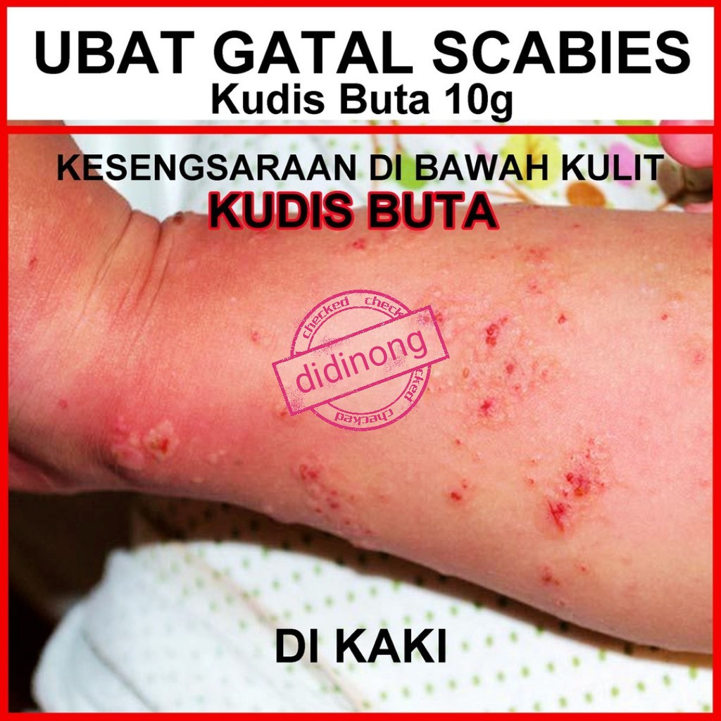 Ubat Gatal Kulit Kudis Scabies Allergy Kucing Kutu Hama Kudis Buta Pijat Semut Kurap Panau Kelangkang Ekzima Shopee Malaysia