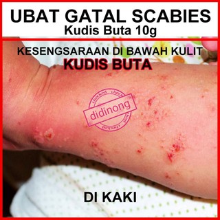 Ubat Gatal Kulit Kudis (Scabies) Allergy Kucing Kutu/Hama Kudis Buta