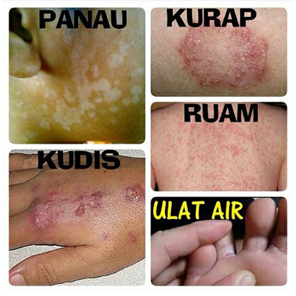 Ubat tradisional untuk Panau Kurap Kudis Ekzema Jerawat ...